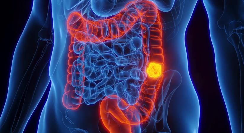 Elképesztő felfedezés: megtalálhatták a vastagbélrák rejtett okozóját