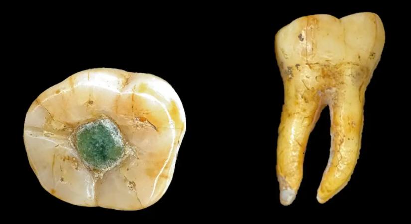 A maják drágakövet használtak fogtömésre