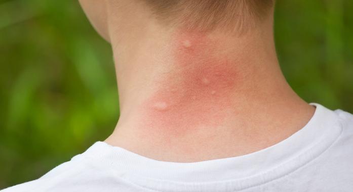 Rovarcsípések mikor ártalmatlan, és mikor veszélyes?