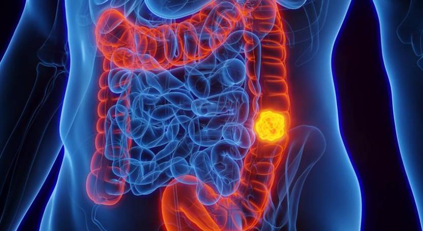 A vastagbélrák 4 legkorábbi tünete: szakorvos mondta el, hogy mikre kell figyelni