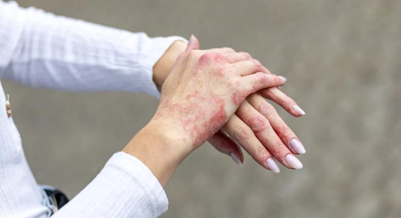 Ekcémával küzdesz? Ez a gyógynövény ott hever az orrod előtt, csak fel kell szedned