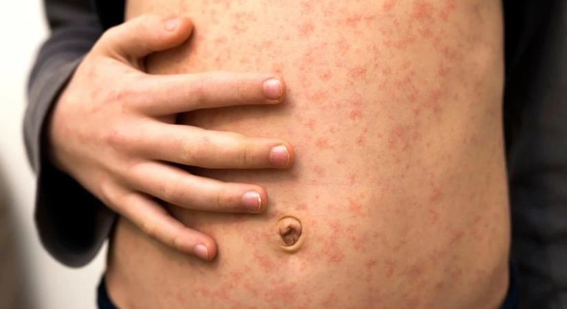 Újabb kanyarós megbetegedéseket regisztráltak Kárpátalján