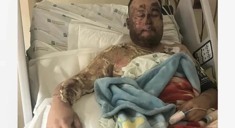 Elvesztette kezét az édesapa egy brutális áramütésben, lánya macskáját akarta megmenteni