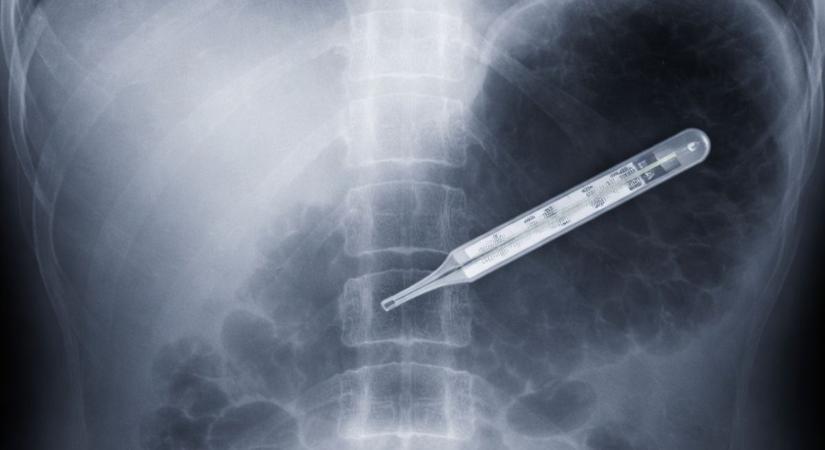 Gyomorfájdalmakra panaszkodott: 20 évig élt higanyos hőmérővel a hasában egy férfi