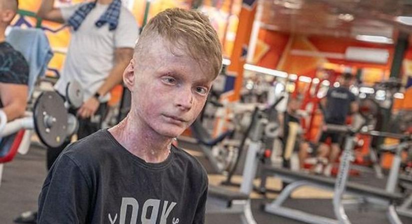 „Nagyon fájnak” – rengeteg seb borítja a pillangóbőrrel született Flórián testét, nagy a baj
