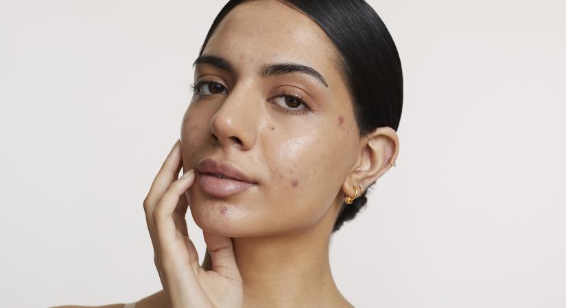 Pattanások 30 felett? 5 zseniális újdonság, ami segít leszámolni a felnőttkori aknéval