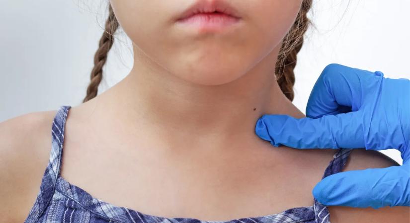 Veszélyes csomók, anyajegyek a gyereknél: vedd észre időben!