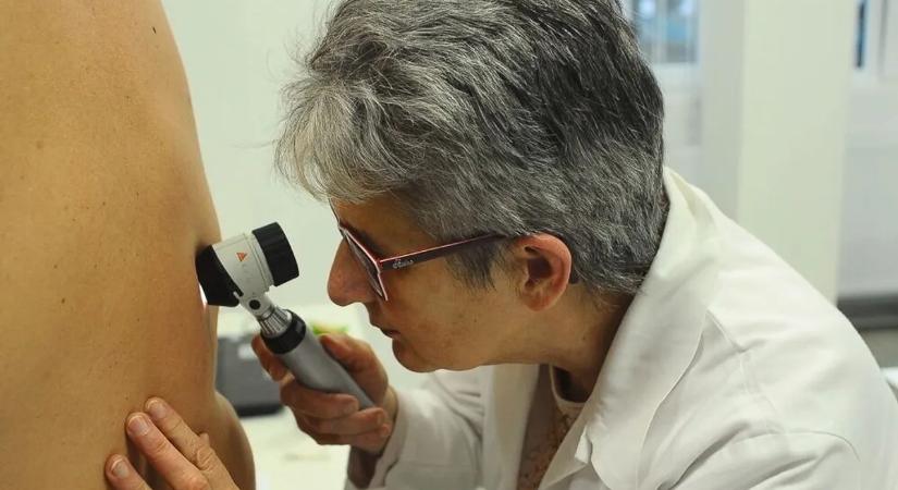 Országos bőrrákszűrési program indult – íme a helyszínek és a tudnivalók