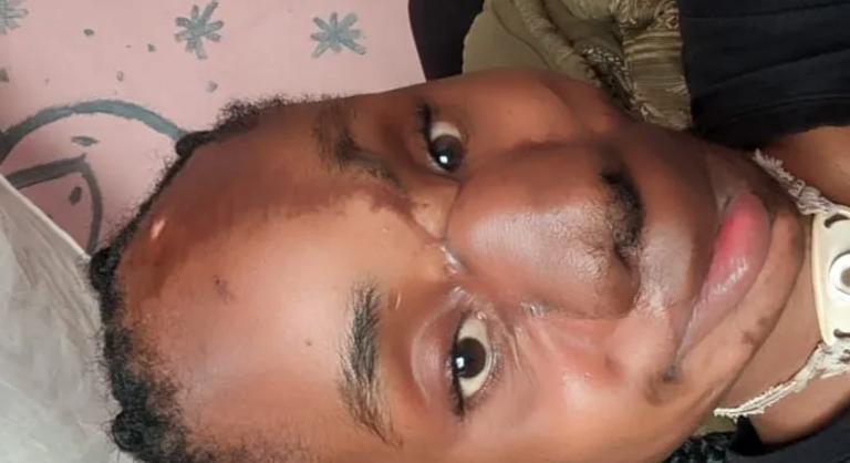 Kettévált a 14 éves lány arca, miután öt lövést kapott a fejébe