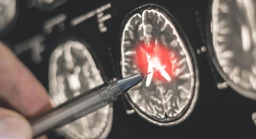 Új kutatás: ez az egyszerű szokás segíthet megelőzni a demenciát