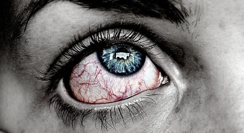 Bixonimania - egy szörnyű szembetegség, amiről hazudtak a tudósok