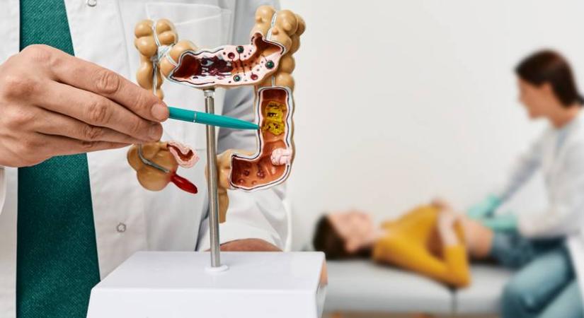 Így rombolhatja a bélfalat a kezeletlen gyulladás – Miért nem szabad félreérteni az IBS-t?
