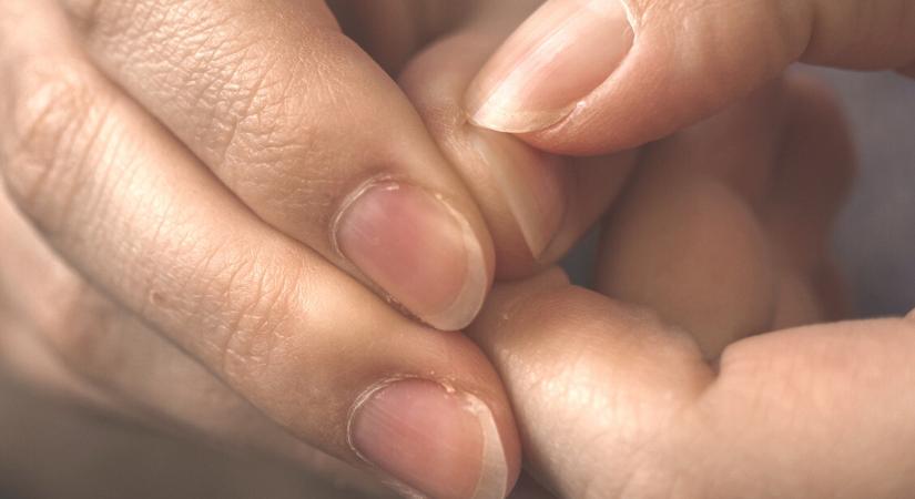 Hiányállapotról árulkodhat a körmöd – ezt figyeld meg rajta