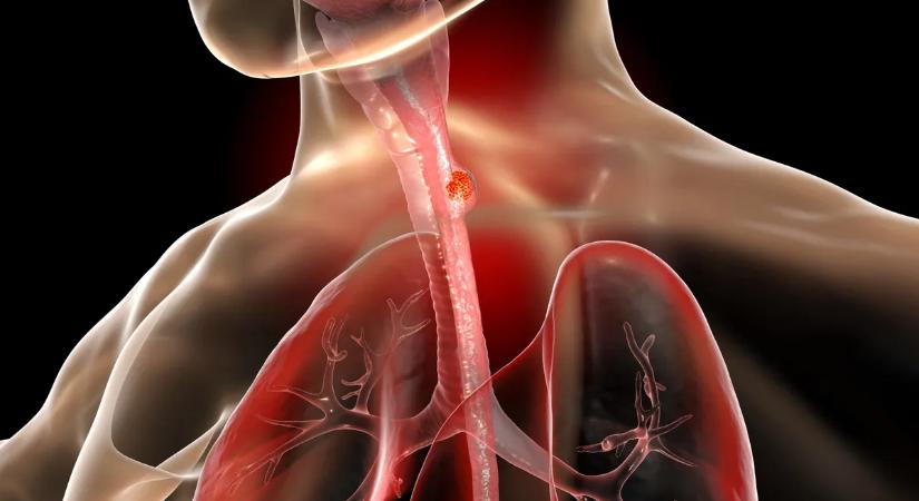 Észre sem veszed, pedig a szemed előtt van a halálos rák legelső jele