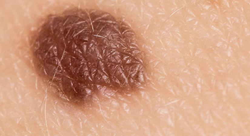 Megdöbbentő egyetemi tanulmány: bőrrákot okozhat ez a népszerű étel