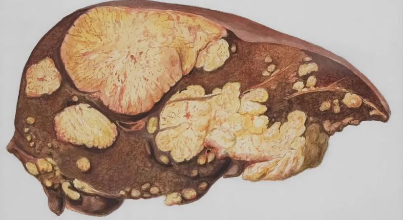 Két ismert gyógyszer adhat új reményt a zsírmáj kezelésében