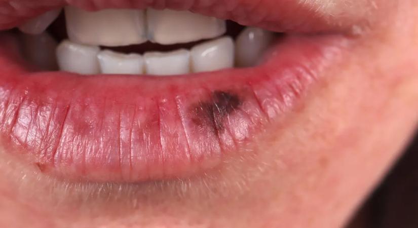 Egészségesnek hitték, pedig a bőrrák előidézője lehet ez a népszerű étel