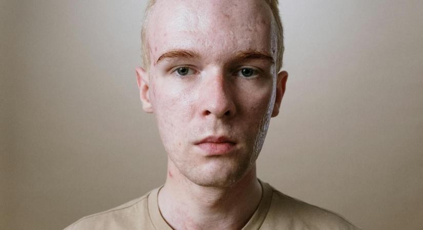 Mivel jár a magas DHT hormonszint?