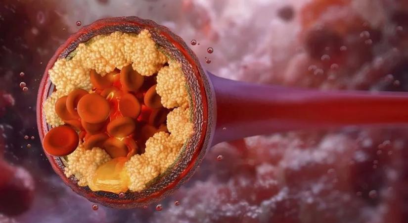 Felfedezték a koleszterin csökkentésének egy forradalmi új módszerét