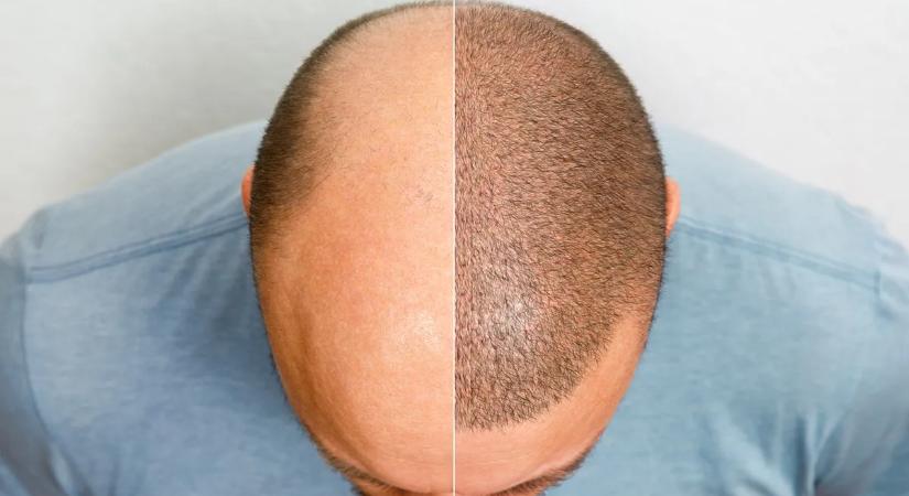 Hajbeültetésen gondolkodsz? Ezt mindenképp tudnod kell