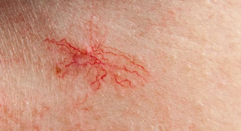 Májzsugor jele az arcon: így változik meg a bőr