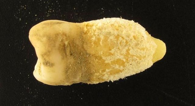 Skarlátot okozó baktériumot fedeztek fel egy középkori fogban