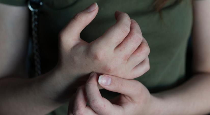Hónapokig csak viszketett a bőre, végül olyat találtak az orvosok, ami az életébe is kerülhet