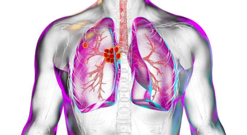 Azt hittük legyőztük, de most visszatért: újra terjed a halálos kór