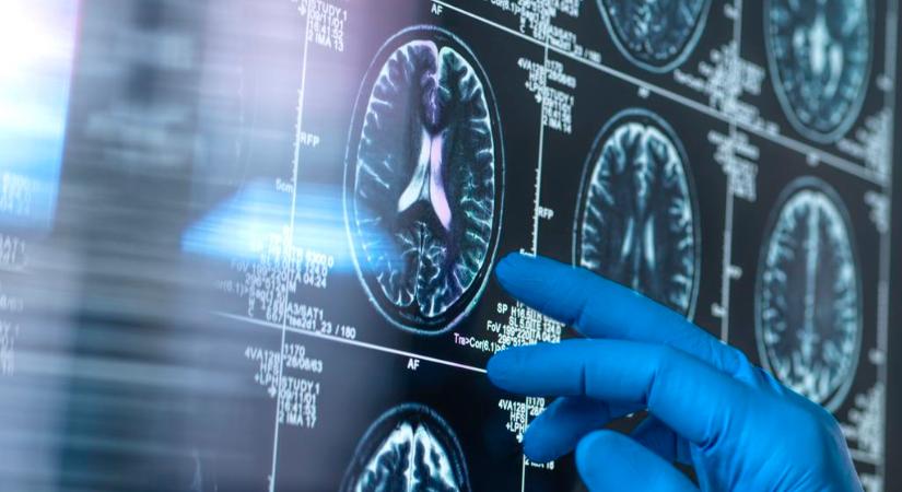 Ez a tünet évekkel előre jelezheti az Alzheimer-kórt