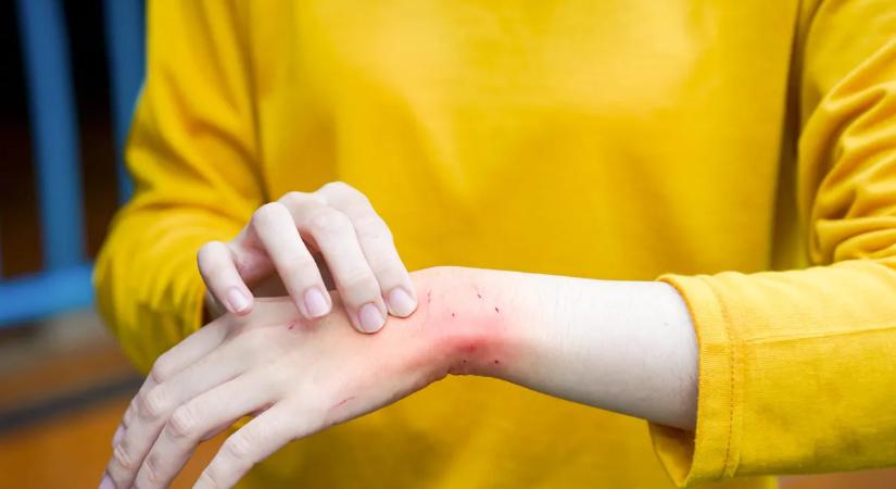 10 gyakori ok, amitől belobbanhat az ekcéma