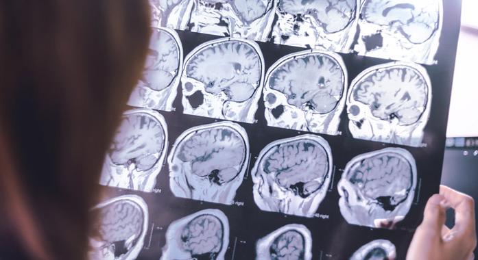 Szubklinikus stroke – A „néma” agyi károsodás