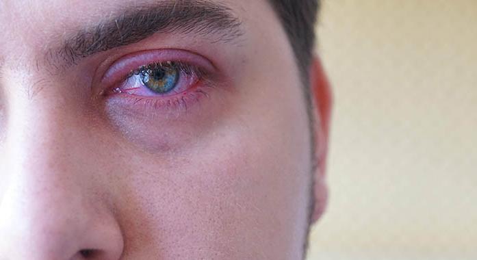 Szemhéjszéli gyulladás (blepharitis)