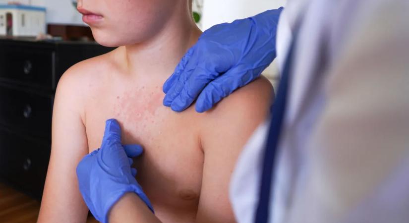 Könnyen összetéveszthető mással a súlyos, gyerekeket támadó betegség