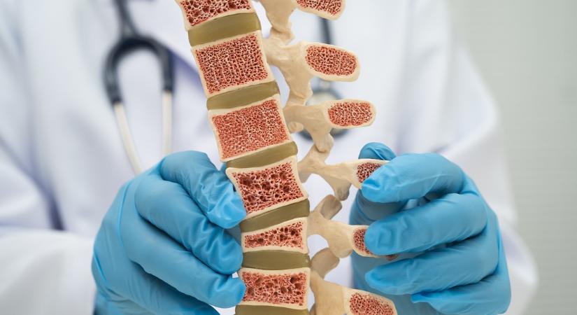 Ez az új felfedezés visszafordíthatja a csontritkulást