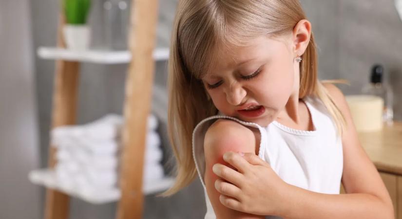 Ekcémás a gyereked? Sokkoló, de ez a szokás tovább súlyosbíthatja a tüneteket