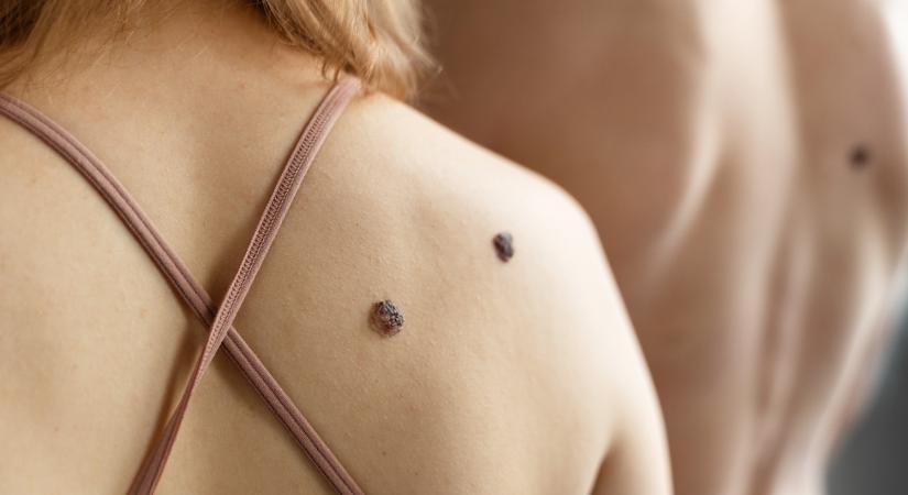 Anyajegy eltávolítás – mikor kell lépni?