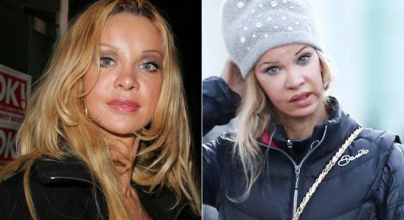 Plasztikrémmé változott az egykor gyönyörű arcú modell: rá sem ismerni plasztikái után