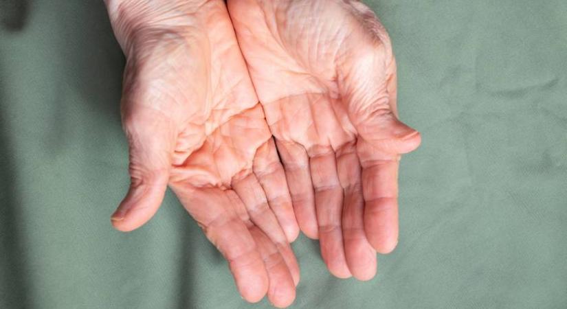 Bajt jelez, ha csomók vannak a tenyeredben: ezek a cukorbetegség rejtett jelei