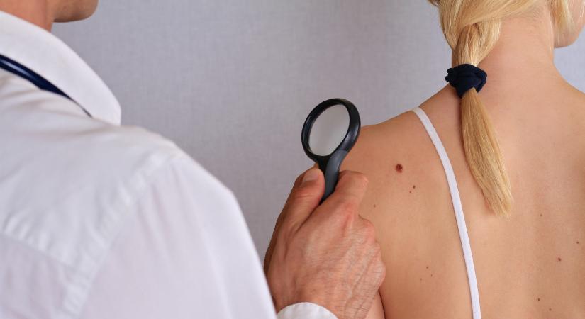 Zavaró anyajegy: most kell kezeltetni – Nyáron ezért okoz több bajt a bőrgyógyász szerint