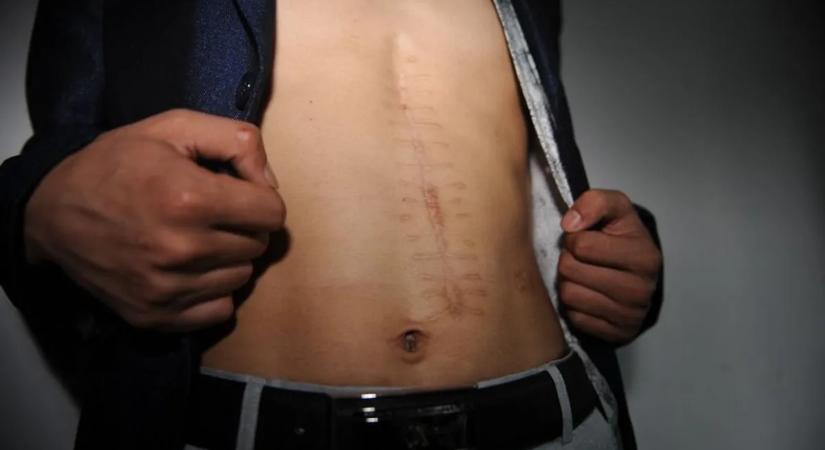 Miért nem tűnnek el soha a sebhelyek?