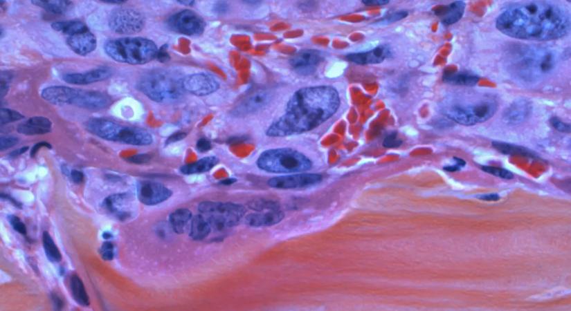 Riasztó trend: egyre több fiatalnál diagnosztizálnak rákot, ez állhat a háttérben