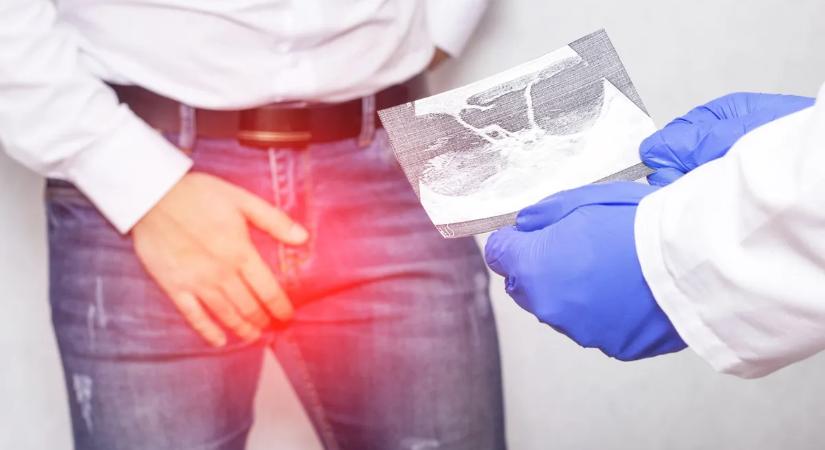 Megdöbbentő mi okozott péniszrákot a fiatal férfinél – Erre figyelj, hogy te ne járj így