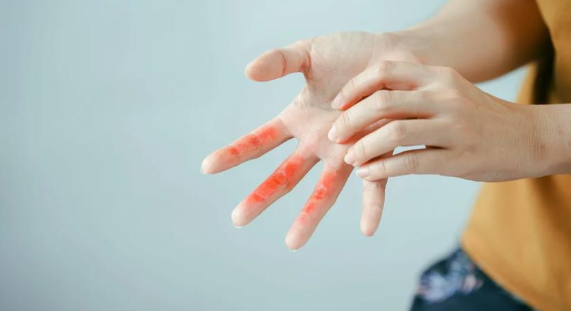 Máig létezik és még mindig szélsebesen terjed az ótvar – így ismerheted fel