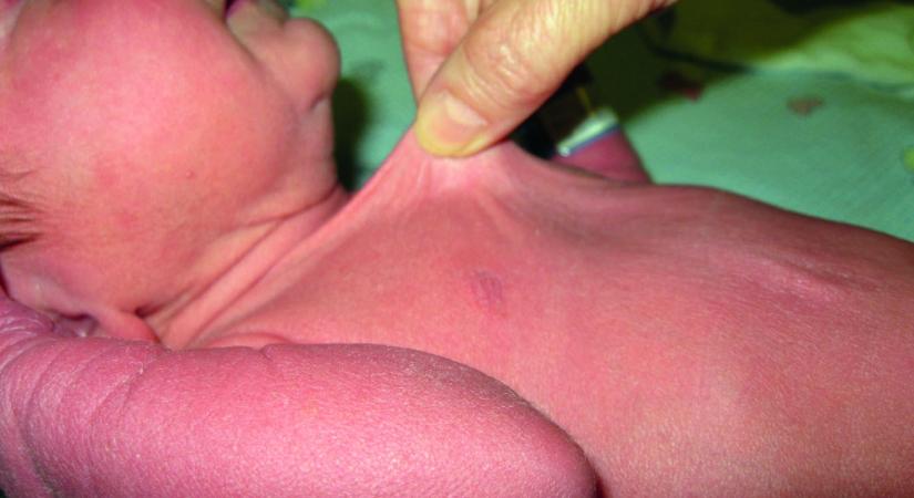 Újszülöttkori bőrelváltozások és terápiájuk