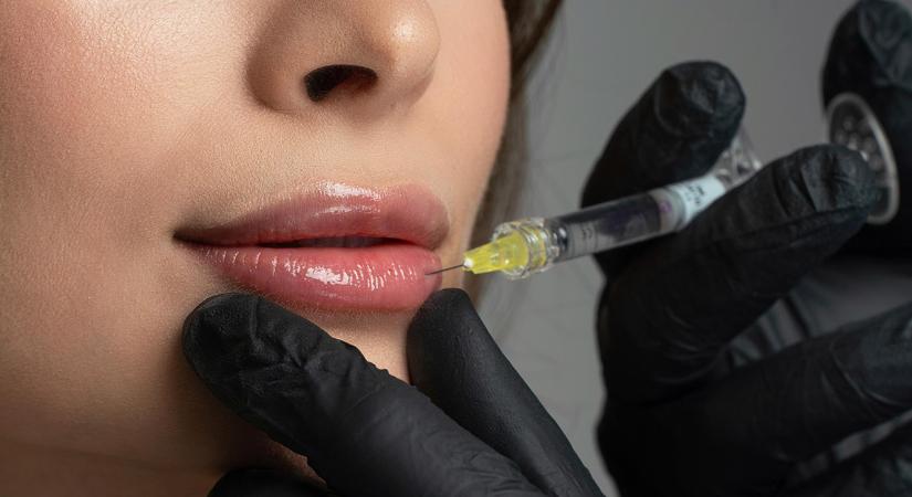 Engedély nélkül töltött ajkakat Békéscsabán egy kozmetikus – pénzbüntetés lett a vége