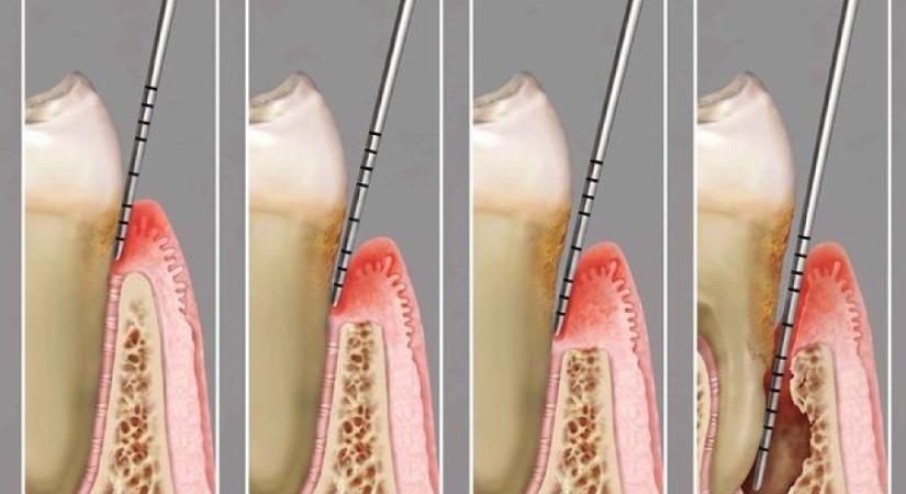 A legtöbb fogatlan ember Európában magyar