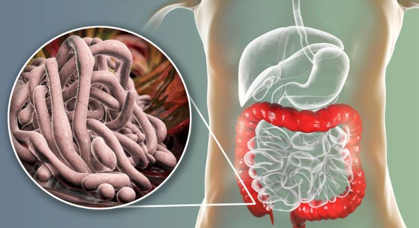 Így terjed a cérnagiliszta-fertőzés: ezt kell tudni a bélparazitáról, amely éjszaka jelentkező végbéltáji viszketést okoz