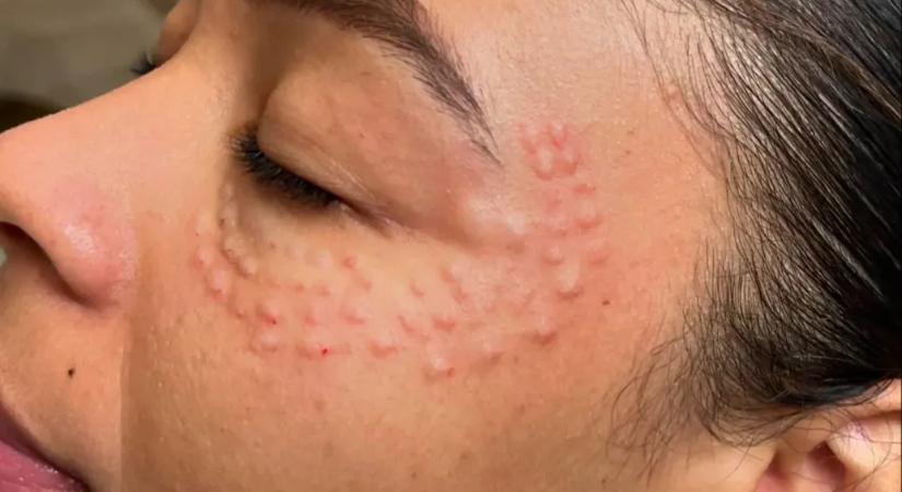 A botox helyett a lazacsperma az új bőrfiatalító őrület