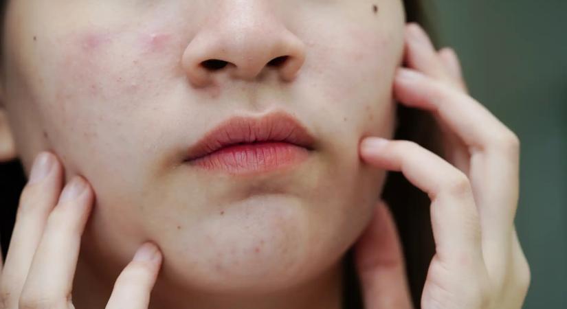 Semmelweis Egyetem: Allergiát és gyulladást okozhat a túlzásba vitt kamaszkori bőrápolás