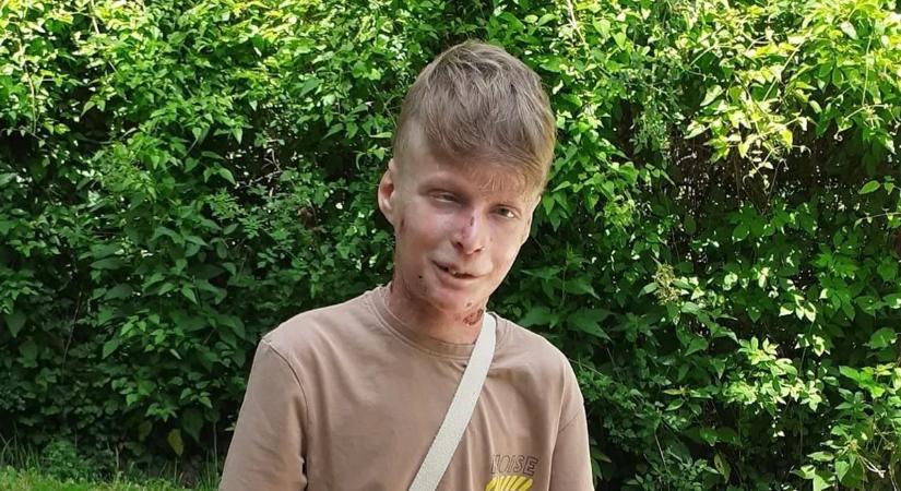 "Lélekben ott leszek veletek az összes napon!" – így érettségizik a pillangóbőrrel küzdő Flórián